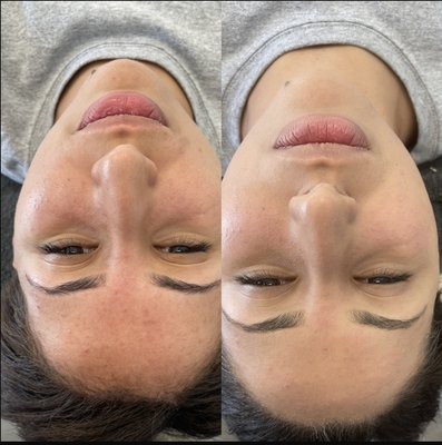 Before and After Dermaplaning, Extractions, Chemical Exfoliation and Alginate Mask. - Give your skin a major boost with dermaplaning! Remove all peach fuzz and dry skin to reveal lighter, brighter skin in just one hour. Great for all skin types.