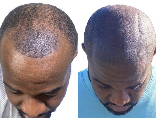 Hairline Restoration - Hair line restoration is a procedure done by micro scalp pigmentation (cosmetic tattoo), to create a more fuller or thicker hair. Consultation via phone or in person is required prior to scheduling for procedure. Same day treatment is available. Hairline Restoration - Hair line restoration is a procedure done by micro scalp pigmentation (cosmetic tattoo), to create a more fuller or thicker hair. Consultation via phone or in person is required prior to scheduling for procedure. Same day treatment is available.