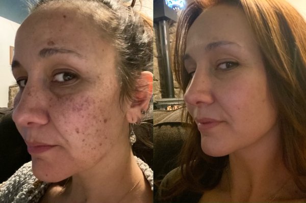 IPL Therapy with Forever Young BBL™ - Featured in this powerful image series is a client's journey through combating acne and acne scarring. Initially facing these skin challenges, she received our specialized IPL Therapy with Forever Young BBL™. The transformation is astonishing: her acne and scarring are significantly reduced, revealing a smoother, clearer complexion.