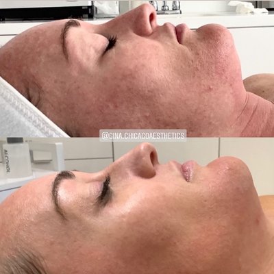 Skincare Treatments - We offer a wide range of skincare treatments including Hydrafacial's and medical grade customized facials to laser hair removal and capillary correction to microneedling and chemical peels. Skincare Treatments - We offer a wide range of skincare treatments including Hydrafacial's and medical grade customized facials to laser hair removal and capillary correction to microneedling and chemical peels.