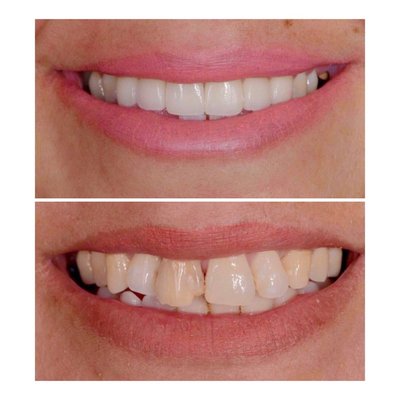 Before and After - All In One Dental provides a wide variety of dental services and procedures to address all of our patients’ dental health needs. By combining quality patient care with up-to-date technology, we are able to treat patients of all ages in a comfortable and relaxing setting. Our dentist and highly trained staff are trained to not only treat patients but to identify what caused the health concern in the first place. This approach sets patients of All In One Dental on the road to recovery and long term oral health.

We offer a wide variety of services for patients throughout the Los Angeles California area. Our patients depend on Dr. Sooferi to meet all of their oral healthcare needs. Whether you need preventative care, restorative solutions or a smile makeover, we can help.