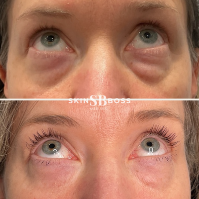Agnes-RF - Agnes RF is a one of a kind non-surgical Radio Frequency (RF) platform offered at Skin Boss. Agnes RF sculpts and contours the face, neck, chin as well as other small body areas. It can also treat upper and lower eye bags and hyperhidrosis. This treatment creates more youthful looking skin by stimulating collagen and elastin production, providing long lasting unmatched results without surgery. Agnes-RF - Agnes RF is a one of a kind non-surgical Radio Frequency (RF) platform offered at Skin Boss. Agnes RF sculpts and contours the face, neck, chin as well as other small body areas. It can also treat upper and lower eye bags and hyperhidrosis. This treatment creates more youthful looking skin by stimulating collagen and elastin production, providing long lasting unmatched results without surgery.