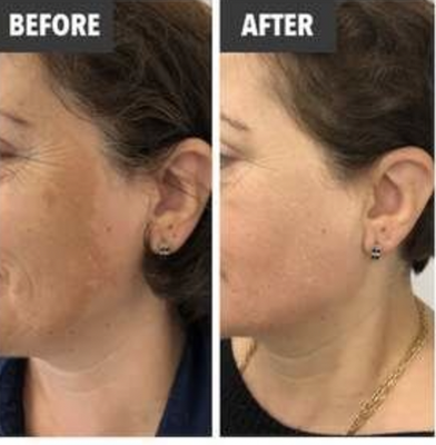 PRP Vampire Facial - The potential benefits of PRP have led to widespread interest in its use for anti-aging and regenerative purposes. The healing properties of the blood components in PRP can be used as a cosmetic treatment for the following:

Reducing fine lines and wrinkles
Tightening and toning skin
Mild collagen and volume loss
Crow’s feet and dark under eye circles
Acne scarring
Rosacea
Stimulates new cell growth
Improves skin tone and texture
Improves skin complexion
Helps with first signs of ageing
Improves skin complexion

PRP therapy is predominantly used on the face, particularly around the eyes, mouth and nose although it may be used on the backs of the hands and all over the body, more commonly the décolletage to give a more youthful and radiant appearance.