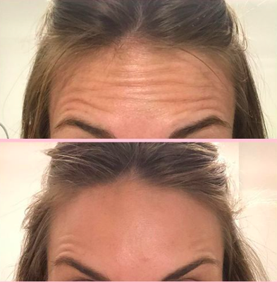 Botox - Plump's Botox Wrinkle Releaser Treatment - starting with a $245.00 minimum and priced at $13.50 per unit! Botox - Plump's Botox Wrinkle Releaser Treatment - starting with a $245.00 minimum and priced at $13.50 per unit!