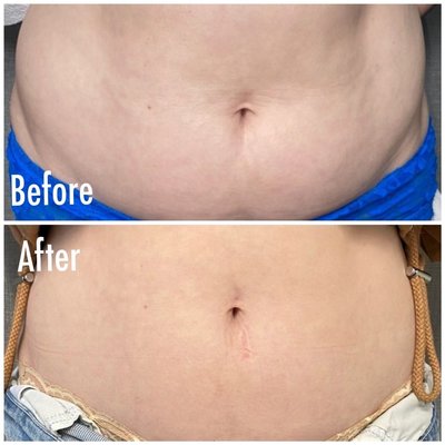 Body Sculpting - Body sculpting is possible using our Trusculpt ID and Trusculpt Flex systems. We also have Genius RF microneedling to deal with stretch marks and cellulite. Body Sculpting - Body sculpting is possible using our Trusculpt ID and Trusculpt Flex systems. We also have Genius RF microneedling to deal with stretch marks and cellulite.