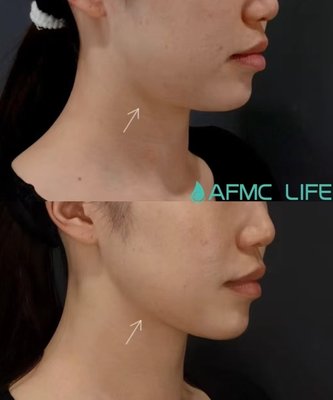 Jawline Enhancement - Jawline enhancement procedures sculpt and define the jaw for a sharper, more balanced facial contour. Jawline Enhancement - Jawline enhancement procedures sculpt and define the jaw for a sharper, more balanced facial contour.