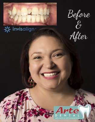 Invisalign Smile Makeover - Patient had an extra tooth between her two front teeth.  We removed it and closed the space with Invisalign.  Once she was done, we reshaped the edges of her front teeth and she did bleaching.  Life changing!