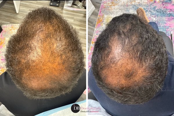 Hair Regeneration - The treatment involves applying exosomes to areas of the scalp experiencing hair thinning or hair loss. These exosomes deliver powerful growth factors directly to dormant or weakened hair follicles, enhancing their activity and encouraging the growth of stronger, healthier hair. This process not only increases hair density but can also improve hair's overall thickness and texture. Hair Regeneration - The treatment involves applying exosomes to areas of the scalp experiencing hair thinning or hair loss. These exosomes deliver powerful growth factors directly to dormant or weakened hair follicles, enhancing their activity and encouraging the growth of stronger, healthier hair. This process not only increases hair density but can also improve hair's overall thickness and texture.