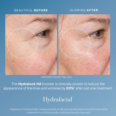 Hydrafacial - The Deluxe Hydrafacial offers a luxurious skincare experience that deeply cleanses, exfoliates, and hydrates the skin. Infused with potent serum filled boosters tailored to individual skin concerns, and professional strength therapeutic light energy to treat skin from within, this treatment leaves the complexion radiant and rejuvenated.