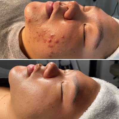 Acne Program - Take a peak at some of our client’s Acne Program results!