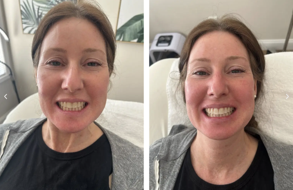 Teeth Whitening - Teeth Whitening Teeth Whitening - Teeth Whitening