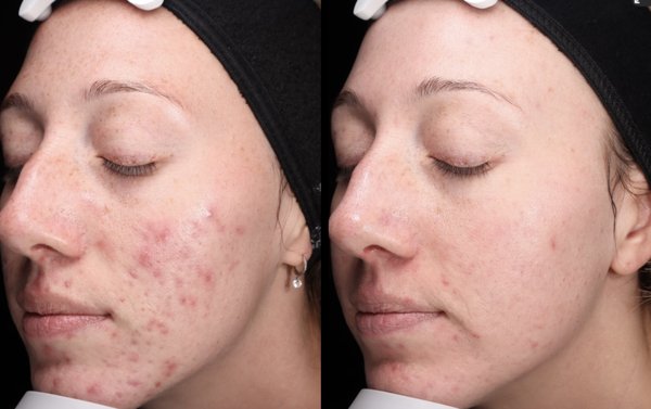 Laser Facial Results - A customized acne regimen featuring the AdvaTX laser facial, combined with tailored homecare, offers a comprehensive solution for achieving clearer, healthier skin. The AdvaTX laser facial uses advanced yellow and infrared laser technology to target and reduce acne-causing bacteria, minimize inflammation, and promote collagen production for smoother skin. Complementing the in-office treatments, a personalized homecare routine includes gentle cleansers, acne-fighting serums with ingredients like salicylic acid or benzoyl peroxide, and non-comedogenic moisturizers to maintain skin hydration without clogging pores. This synergistic approach not only addresses active breakouts but also helps prevent future acne, leading to a significant improvement in skin clarity and texture over time. Laser Facial Results - A customized acne regimen featuring the AdvaTX laser facial, combined with tailored homecare, offers a comprehensive solution for achieving clearer, healthier skin. The AdvaTX laser facial uses advanced yellow and infrared laser technology to target and reduce acne-causing bacteria, minimize inflammation, and promote collagen production for smoother skin. Complementing the in-office treatments, a personalized homecare routine includes gentle cleansers, acne-fighting serums with ingredients like salicylic acid or benzoyl peroxide, and non-comedogenic moisturizers to maintain skin hydration without clogging pores. This synergistic approach not only addresses active breakouts but also helps prevent future acne, leading to a significant improvement in skin clarity and texture over time.