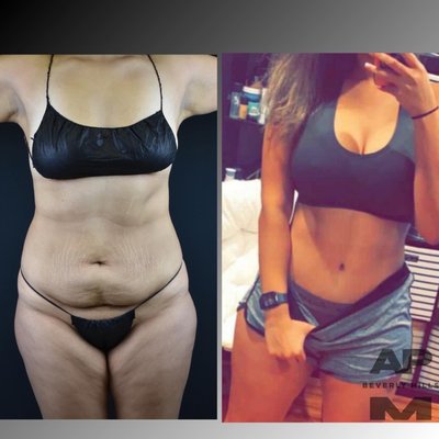 Tummy Tuck and BBL - This lovely patient underwent a tummy tuck, breast augmenation, lipo360, and BBL to accentuate her curves. Tummy Tuck and BBL - This lovely patient underwent a tummy tuck, breast augmenation, lipo360, and BBL to accentuate her curves.