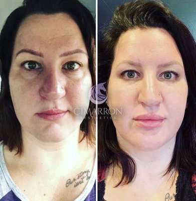Microneedling - Microneedling is a procedure aimed to stimulate the body’s own collagen production to reduce the appearance of fine lines, pores, wrinkles, stretch marks, skin laxity, and scarring. Topical lidocaine, along with the high-speed automated needling motion, minimizes pain and discomfort. Our medical-grade micro needling is far more efficient than any needling/roller or manual procedure you can purchase at home. At home rollers cannot generate the same depth of microholes in the skin and will not yield the same consistent results.