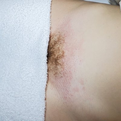 BEFORE/AFTER Bikini Sugaring - After a long Winter's nap... this client is now off to her vacation in a swim suit she usually hides under shorts! BEFORE/AFTER Bikini Sugaring - After a long Winter's nap... this client is now off to her vacation in a swim suit she usually hides under shorts!