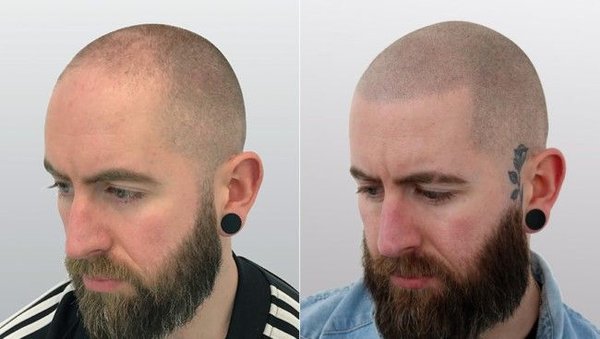 Shaved Head Effect SMP – Natural Hairline Restoration - At Grizzly Scalp, we treated a male client with advanced hair loss who wanted a natural shaved head look. Using our Shaved Head Effect Scalp Micropigmentation (SMP) technique, we recreated a realistic hairline and added consistent coverage across the scalp.
The pigments were carefully matched to his natural tone, giving him the appearance of a clean buzz cut. The transformation was immediate – from visible baldness to a sharp, confident style that looks natural from every angle. Shaved Head Effect SMP – Natural Hairline Restoration - At Grizzly Scalp, we treated a male client with advanced hair loss who wanted a natural shaved head look. Using our Shaved Head Effect Scalp Micropigmentation (SMP) technique, we recreated a realistic hairline and added consistent coverage across the scalp.
The pigments were carefully matched to his natural tone, giving him the appearance of a clean buzz cut. The transformation was immediate – from visible baldness to a sharp, confident style that looks natural from every angle.