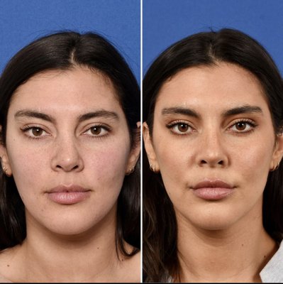 Botox & Filler - Dr. House's goal is to always enhance the natural beauty of his patients. With subtle “actors-dose” Botox to help raise the tail of the brows, and gentle filler to the lips, cheeks, and jaw, he were able to create a natural, yet refined look. Botox & Filler - Dr. House's goal is to always enhance the natural beauty of his patients. With subtle “actors-dose” Botox to help raise the tail of the brows, and gentle filler to the lips, cheeks, and jaw, he were able to create a natural, yet refined look.