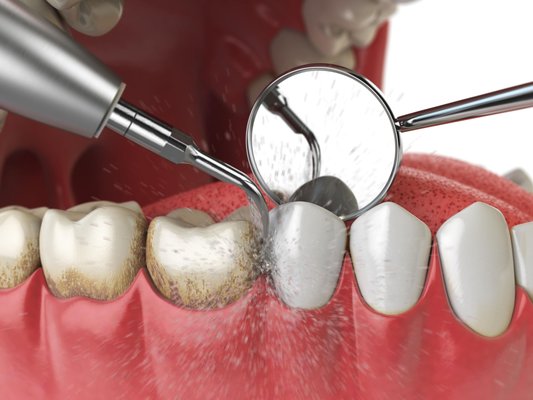 Periodontic & Prevention - Our general dentistry offers periodontic procedures to diagnose, treat, and prevent gum disease, ensuring healthy gums and supporting bone for a strong, beautiful smile.
What is Periodontics?
Periodontics is the branch of dentistry dealing with the prevention, diagnosis, and treatment of gum disease and related conditions.
Periodontic Procedures
Deep Cleaning (Scaling and Root Planing)
- A thorough cleaning treatment to remove plaque, tartar, and bacteria from below the gum line
- Treats gum disease and prevents further damage
- Involves scaling to remove plaque and tartar, and root planing to smooth out roots
- Helps prevent bad breath, loose teeth, and gum recession
Regular Cleaning (Prophylaxis)
- A routine cleaning treatment to remove plaque, tartar, and stains from teeth
- Promotes healthy gums and prevents cavities
- Involves a thorough examination, cleaning, and polishing of teeth
- Recommended every 6 months for optimal oral health
Polishing
- A cosmetic cleaning treatment to remove surface stains and smooth out teeth
- Enhances appearance and removes minor imperfections
- Involves using a polishing tool and abrasive paste to gently remove stains
- Can be combined with regular cleaning for optimal results
Fluoride Treatment
- A preventative treatment to strengthen tooth enamel and prevent decay
- Involves applying a fluoride gel or varnish to teeth
- Helps prevent sensitivity and promotes healthy teeth
- Recommended for children and adults with a high risk of tooth decay
Periodontal Maintenance
- Regular cleanings for patients with a history of gum disease
- Maintains gum health and prevents recurrence of gum disease
- Involves a thorough examination, cleaning, and polishing of teeth
- Recommended every 3-4 months for optimal results
Air Abrasion Cleaning
- A gentle cleaning treatment using compressed air and abrasive particles
- Removes stains and plaque without damaging teeth or gums
- Suitable for sensitive teeth and gums
- Can be used for cleaning hard-to-reach areas and removing minor imperfections
Gingival Irrigation
- A gentle treatment to remove plaque, bacteria, and debris from between teeth and below the gum line
- Involves using a soft stream of water or antibacterial solution to clean the gums
- Helps prevent gum disease, bad breath, and gum recession
- Can be combined with regular cleaning for optimal results
Periodontal Antibiotics
- A treatment to control bacterial infections in the gums
- Involves applying antibiotics directly to the affected area
- Helps reduce inflammation, prevent further infection, and promote healing
- May be recommended in conjunction with deep cleaning or periodontal maintenance Periodontic & Prevention - Our general dentistry offers periodontic procedures to diagnose, treat, and prevent gum disease, ensuring healthy gums and supporting bone for a strong, beautiful smile.
What is Periodontics?
Periodontics is the branch of dentistry dealing with the prevention, diagnosis, and treatment of gum disease and related conditions.
Periodontic Procedures
Deep Cleaning (Scaling and Root Planing)
- A thorough cleaning treatment to remove plaque, tartar, and bacteria from below the gum line
- Treats gum disease and prevents further damage
- Involves scaling to remove plaque and tartar, and root planing to smooth out roots
- Helps prevent bad breath, loose teeth, and gum recession
Regular Cleaning (Prophylaxis)
- A routine cleaning treatment to remove plaque, tartar, and stains from teeth
- Promotes healthy gums and prevents cavities
- Involves a thorough examination, cleaning, and polishing of teeth
- Recommended every 6 months for optimal oral health
Polishing
- A cosmetic cleaning treatment to remove surface stains and smooth out teeth
- Enhances appearance and removes minor imperfections
- Involves using a polishing tool and abrasive paste to gently remove stains
- Can be combined with regular cleaning for optimal results
Fluoride Treatment
- A preventative treatment to strengthen tooth enamel and prevent decay
- Involves applying a fluoride gel or varnish to teeth
- Helps prevent sensitivity and promotes healthy teeth
- Recommended for children and adults with a high risk of tooth decay
Periodontal Maintenance
- Regular cleanings for patients with a history of gum disease
- Maintains gum health and prevents recurrence of gum disease
- Involves a thorough examination, cleaning, and polishing of teeth
- Recommended every 3-4 months for optimal results
Air Abrasion Cleaning
- A gentle cleaning treatment using compressed air and abrasive particles
- Removes stains and plaque without damaging teeth or gums
- Suitable for sensitive teeth and gums
- Can be used for cleaning hard-to-reach areas and removing minor imperfections
Gingival Irrigation
- A gentle treatment to remove plaque, bacteria, and debris from between teeth and below the gum line
- Involves using a soft stream of water or antibacterial solution to clean the gums
- Helps prevent gum disease, bad breath, and gum recession
- Can be combined with regular cleaning for optimal results
Periodontal Antibiotics
- A treatment to control bacterial infections in the gums
- Involves applying antibiotics directly to the affected area
- Helps reduce inflammation, prevent further infection, and promote healing
- May be recommended in conjunction with deep cleaning or periodontal maintenance
