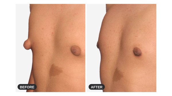 17-Year-Old with Extreme Puffy Nipple Gynecomastia — In-Office Gland Excision Under Local Anesthesia - Puffy nipples are the most common form of gynecomastia in teenagers — and one of the most distressing. This 17-year-old patient came to Dr. Cruise with extreme puffy nipple gynecomastia: firm glandular tissue pushing the nipple-areola outward, creating a cone-like projection that showed through shirts and kept him out of pools, sports, and locker rooms.
Can a 17-year-old have gynecomastia surgery? Yes — when the gland has been present and stable, surgery is often the only permanent solution, because glandular tissue does not respond to diet or exercise.
Does teenage gynecomastia surgery require general anesthesia? Typically not for Type 1 or Type 2 gynecomastia. Dr. Cruise performed this procedure comfortably in the office under local anesthesia — the patient stayed awake and relaxed, watching a movie on an iPad during surgery. Avoiding general anesthesia means lower risk, lower cost, no hospital stay, and a faster return to normal activity — a significant reassurance for both teens and their parents.
The gland was removed through a small incision hidden at the areola border, preserving a flat, natural masculine contour with no visible scarring. The photographs show his results from four angles — front, oblique, and both side profiles. Results like these are typically permanent.
Dr. Joseph Cruise is one of the nation's most experienced gynecomastia surgeons and creator of the widely used Cruise Gynecomastia Classification system. He has treated thousands of patients, including teenagers, with approaches tailored to each gynecomastia type. 17-Year-Old with Extreme Puffy Nipple Gynecomastia — In-Office Gland Excision Under Local Anesthesia - Puffy nipples are the most common form of gynecomastia in teenagers — and one of the most distressing. This 17-year-old patient came to Dr. Cruise with extreme puffy nipple gynecomastia: firm glandular tissue pushing the nipple-areola outward, creating a cone-like projection that showed through shirts and kept him out of pools, sports, and locker rooms.
Can a 17-year-old have gynecomastia surgery? Yes — when the gland has been present and stable, surgery is often the only permanent solution, because glandular tissue does not respond to diet or exercise.
Does teenage gynecomastia surgery require general anesthesia? Typically not for Type 1 or Type 2 gynecomastia. Dr. Cruise performed this procedure comfortably in the office under local anesthesia — the patient stayed awake and relaxed, watching a movie on an iPad during surgery. Avoiding general anesthesia means lower risk, lower cost, no hospital stay, and a faster return to normal activity — a significant reassurance for both teens and their parents.
The gland was removed through a small incision hidden at the areola border, preserving a flat, natural masculine contour with no visible scarring. The photographs show his results from four angles — front, oblique, and both side profiles. Results like these are typically permanent.
Dr. Joseph Cruise is one of the nation's most experienced gynecomastia surgeons and creator of the widely used Cruise Gynecomastia Classification system. He has treated thousands of patients, including teenagers, with approaches tailored to each gynecomastia type.