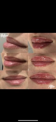 Lip enhancements with filler! Natural subtle approach. - Lip enhancement with filler! Natural subtle approach.