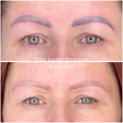 Pico Laser Tattoo Removal / Pigment Lightening - Picosecond Laser Tattoo Removal: Safe, Effective, and Fast
Say goodbye to unwanted tattoos with the power of cutting-edge Picosecond Laser Technology. Our advanced tattoo removal service offers faster results, minimal discomfort, and superior skin care, ensuring you can confidently reclaim your skin.
Whether it’s an old regret or simply a design that no longer suits you, our Picosecond Laser Tattoo Removal is the solution you’ve been looking for. Regain confidence in your skin with safe, proven results.
Schedule your consultation today and take the first step towards clear, ink-free skin!