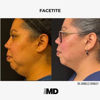 FaceTite - FaceTite is a minimally-invasive alternative to a surgical facelift and a contouring solution for the face and neck areas. Utilizing radio frequency technology, this treatment helps to improve your facial appearance, minimizing any signs of aging and revitalizing a youthful look. Overall, a non-surgical facelift treatment addresses skin laxity in the face/neck area, tightens loose skin, and reduces stubborn fat, while providing optimal, natural-looking results.

FaceTite is the next best thing to a traditional facelift without the large scars and extended downtime. This procedure is done in the office by our board-certified plastic surgeon and can be performed on jowls, neck, nasolabial folds, cheeks, and jaw line.