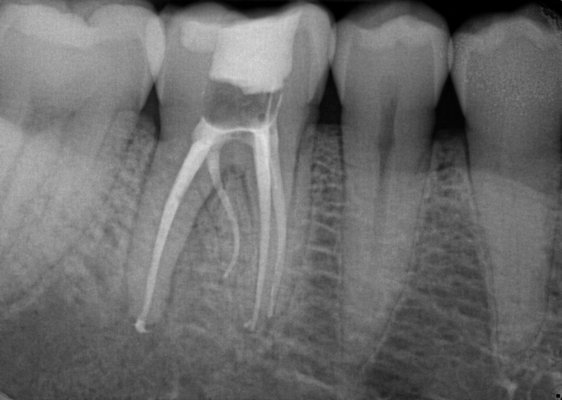 Microscope-Assisted Root Canal Therapy - This case demonstrates microscope-enhanced endodontic treatment with 3D CBCT diagnosis. The patient presented with acute pain due to pulpal infection. Treatment was completed in one visit with resolution of symptoms. Microscope-Assisted Root Canal Therapy - This case demonstrates microscope-enhanced endodontic treatment with 3D CBCT diagnosis. The patient presented with acute pain due to pulpal infection. Treatment was completed in one visit with resolution of symptoms.