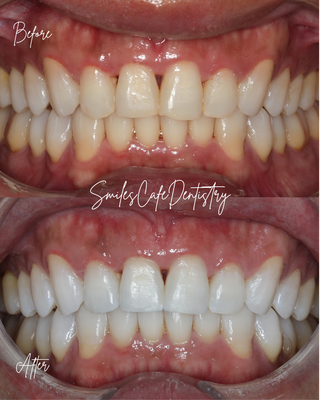 In-Office Zoom Whitening - Results using our in-office Zoom whitening! In-Office Zoom Whitening - Results using our in-office Zoom whitening!
