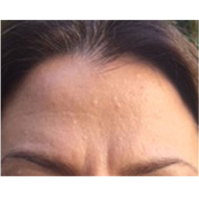 Milia - Client reported that these milia have been lodged in her skin for at least 10 years and finally found out about me through word of mouth. Milia - Client reported that these milia have been lodged in her skin for at least 10 years and finally found out about me through word of mouth.