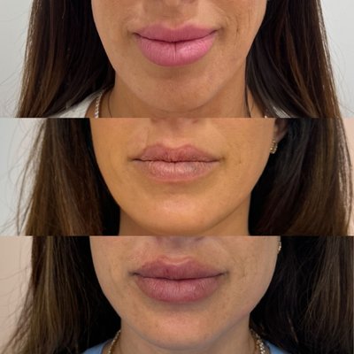 Dissolver - Dissolver, also known as hyaluronidase, is an enzyme that breaks down hyaluronic acid-based fillers. We typically use this to dissolve botched filler causing disfigurement or filler bumps.