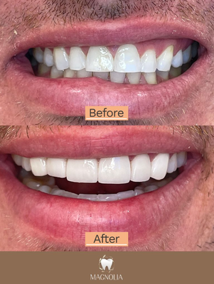 Cosmetic Porcelain Veneers - Veneers are thin porcelain structures that are placed over your teeth during a minimally invasive procedure in order to obtain a flawless smile. Veneers only resurface the front visible part of a tooth. Porcelain veneers are an option for correcting stained, chipped, decayed or crooked teeth.
https://magnoliamoderndental.com/veneers/ Cosmetic Porcelain Veneers - Veneers are thin porcelain structures that are placed over your teeth during a minimally invasive procedure in order to obtain a flawless smile. Veneers only resurface the front visible part of a tooth. Porcelain veneers are an option for correcting stained, chipped, decayed or crooked teeth.
https://magnoliamoderndental.com/veneers/