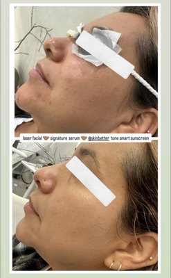 Laser Facial Treatments - Take advantage of our laser facial package at this time, call or text for questions or booking information !