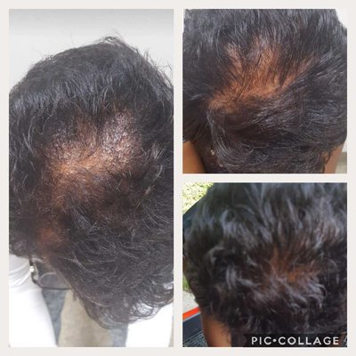 Hair Growth Oil - Clients Growth from Using Our Oil
