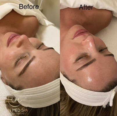 Hydro-Facial - Refresh and revitalize your skin with our signature Hydro-Facial. This non-invasive treatment combines cleansing, exfoliation, and hydration to improve skin tone and texture. Gentle yet effective, the Hydro-Facial is ideal for those looking to reduce dullness and enhance their natural glow in just one visit.