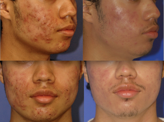 Acne Transformation - Acne Treatment in Scottsdale
Why Professional Care Matters for Clear, Healthy Skin
Acne is one of the most common skin conditions, affecting teens and adults alike. While breakouts may seem temporary, untreated acne can lead to long-term scarring, uneven texture, and dark spots that are much harder to correct later. That’s why seeking professional acne treatment is so important.
At Sensational Skin in Scottsdale, our team, led by Dr. S. Kent Brown, specializes in advanced, medical-grade acne care. With over 25 years of dermatology and aesthetic experience, we provide customized treatment plans to help you control breakouts now and protect your skin for the future.
Types of Acne
Not all acne is the same, and each type requires a unique treatment approach:
Comedonal Acne (Blackheads & Whiteheads): Caused by clogged pores filled with oil and dead skin cells. Often responds well to medical-grade topicals and peels.
Papules & Pustules (Inflammatory Acne): Red bumps or pus-filled bumps caused by clogged and inflamed pores. Best treated with light therapy, prescription topicals, or chemical peels.
Nodular Acne: Large, painful bumps deep under the skin. These carry a high risk of scarring if untreated and require advanced medical management.
Cystic Acne: The most severe form—deep, swollen, painful lesions filled with pus. Almost always requires professional care with prescriptions, lasers, or microneedling to prevent permanent scarring.
Why You Need Medical Acne Treatment
Prevent Scarring – Especially with nodular and cystic acne
Customized Approach – Based on your acne type and severity
Advanced Options – Beyond drugstore products: lasers, microneedling, and prescriptions
Addressing Root Causes – Hormones, genetics, stress, and lifestyle are considered
Long-Term Skin Health – Early treatment means clearer, healthier, more confident skin
Acne Treatments We Offer
At Sensational Skin Scottsdale, we combine advanced therapies to target active acne and long-term skin health:
Medical-Grade Topicals & Prescriptions – Reduce oil production, clear pores, and fight bacteria.
Chemical Peels & Exfoliation – Improve clarity, smooth texture, and reduce pigmentation.
Laser & Light Therapies – Kill acne-causing bacteria and calm inflammation.
Smoothbeam® Laser – A non-ablative laser that shrinks oil glands to reduce breakouts and stimulates collagen to improve early acne scars and fine lines. Safe, effective, with little to no downtime.
Microneedling (MicroPen EVO®) – Boosts collagen to improve scars and refine skin texture.
ZO® Medical Skincare – Prescription-strength skincare for home use to maintain results. Acne Transformation - Acne Treatment in Scottsdale
Why Professional Care Matters for Clear, Healthy Skin
Acne is one of the most common skin conditions, affecting teens and adults alike. While breakouts may seem temporary, untreated acne can lead to long-term scarring, uneven texture, and dark spots that are much harder to correct later. That’s why seeking professional acne treatment is so important.
At Sensational Skin in Scottsdale, our team, led by Dr. S. Kent Brown, specializes in advanced, medical-grade acne care. With over 25 years of dermatology and aesthetic experience, we provide customized treatment plans to help you control breakouts now and protect your skin for the future.
Types of Acne
Not all acne is the same, and each type requires a unique treatment approach:
Comedonal Acne (Blackheads & Whiteheads): Caused by clogged pores filled with oil and dead skin cells. Often responds well to medical-grade topicals and peels.
Papules & Pustules (Inflammatory Acne): Red bumps or pus-filled bumps caused by clogged and inflamed pores. Best treated with light therapy, prescription topicals, or chemical peels.
Nodular Acne: Large, painful bumps deep under the skin. These carry a high risk of scarring if untreated and require advanced medical management.
Cystic Acne: The most severe form—deep, swollen, painful lesions filled with pus. Almost always requires professional care with prescriptions, lasers, or microneedling to prevent permanent scarring.
Why You Need Medical Acne Treatment
Prevent Scarring – Especially with nodular and cystic acne
Customized Approach – Based on your acne type and severity
Advanced Options – Beyond drugstore products: lasers, microneedling, and prescriptions
Addressing Root Causes – Hormones, genetics, stress, and lifestyle are considered
Long-Term Skin Health – Early treatment means clearer, healthier, more confident skin
Acne Treatments We Offer
At Sensational Skin Scottsdale, we combine advanced therapies to target active acne and long-term skin health:
Medical-Grade Topicals & Prescriptions – Reduce oil production, clear pores, and fight bacteria.
Chemical Peels & Exfoliation – Improve clarity, smooth texture, and reduce pigmentation.
Laser & Light Therapies – Kill acne-causing bacteria and calm inflammation.
Smoothbeam® Laser – A non-ablative laser that shrinks oil glands to reduce breakouts and stimulates collagen to improve early acne scars and fine lines. Safe, effective, with little to no downtime.
Microneedling (MicroPen EVO®) – Boosts collagen to improve scars and refine skin texture.
ZO® Medical Skincare – Prescription-strength skincare for home use to maintain results.