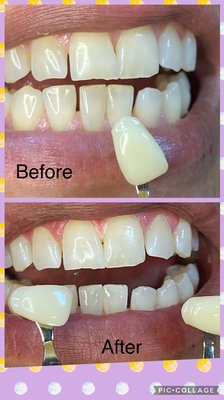 Whiter teeth - Whitening Whiter teeth - Whitening