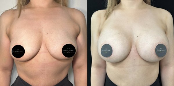 Breast Augmentation - Breast augmentation is a surgical procedure that aims to increase the size and improve the shape of a person's breasts. The procedure involves making an incision in the crease under the breast and inserting an implant beneath the chest muscle.