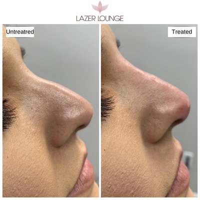 Non surgical rhinoplasty - Non surgical rhinoplasty is a great treatment to enhance symmetry & correct nose shape with fillers. Visit website lazerlounge.com or IG/FB @lazerlounge to learn more Non surgical rhinoplasty - Non surgical rhinoplasty is a great treatment to enhance symmetry & correct nose shape with fillers. Visit website lazerlounge.com or IG/FB @lazerlounge to learn more