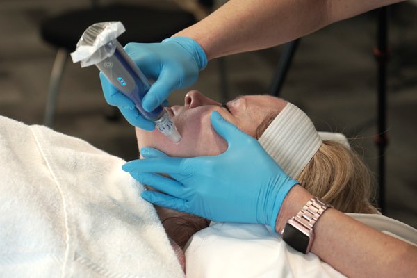 Micronedling - Getting Rid of Acne Scars and Fine Lines! - Micro needling is a skin procedure that creates micro punctures at a controlled level in the skin, with the result being the body naturally responds by repairing the damage. The primary appeal of micro needling is its ability to stimulate growth of collagen and elastin, which is the key to new, youthful-looking skin. It helps with skin rejuvenation, acne scars and stretch marks as well as tackling fine and deep wrinkles.
Because the needle hits a minimal depth, the treatment is relatively painless. A topical anesthetic cream generally is applied 15-20 minutes before the procedure, which will render the treatment virtually pain free.
As this is a medical procedure, a consultation with a trained medical esthetician is essential to determine if you’re a good candidate. As a general guide though, you’ll require three to five treatments, around four weeks apart.