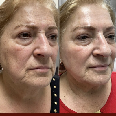 IPL Results - Explore real patient transformations from treatments performed at Hush LA Medspa in Los Angeles. Our gallery features results from IPL IPL Results - Explore real patient transformations from treatments performed at Hush LA Medspa in Los Angeles. Our gallery features results from IPL