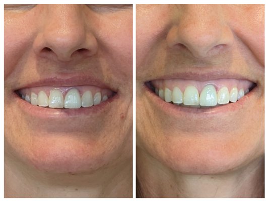 Lip Flip - Just a few units of Botox can help give a fuller appearing upper lip and also soften lines around the lips known as "smoker lines" and correct a "gummy smile"
This patient was treated with four units of Dysport Lip Flip - Just a few units of Botox can help give a fuller appearing upper lip and also soften lines around the lips known as "smoker lines" and correct a "gummy smile"
This patient was treated with four units of Dysport