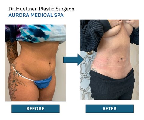 Smart Lipo- with Our Plastic Surgeon - the newest technology of Liposuction that melt fat and tighten the skin with minimum downtime. Done by our surgeons at our surgery suite