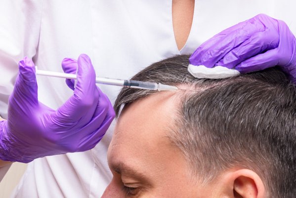 Hair Loss PRP Treatment - (Hair loss consultation required prior to scheduling treatment)
Platelet-rich plasma (PRP): Studies show that this can be a safe and effective hair loss treatment. PRP involves drawing a small amount of your blood, placing your blood into a machine that separates it into parts, and then injecting one part of your blood (the plasma) into the area with hair loss.
The entire procedure takes about 10 minutes and usually doesn’t require any downtime.
You will need to return for repeat injections. Most patients return once a month for 3 months and then once every 3 to 6 months.
Within the first few months of treatment, you may notice that you are losing less or minimal amounts of hair. Hair Loss PRP Treatment - (Hair loss consultation required prior to scheduling treatment)
Platelet-rich plasma (PRP): Studies show that this can be a safe and effective hair loss treatment. PRP involves drawing a small amount of your blood, placing your blood into a machine that separates it into parts, and then injecting one part of your blood (the plasma) into the area with hair loss.
The entire procedure takes about 10 minutes and usually doesn’t require any downtime.
You will need to return for repeat injections. Most patients return once a month for 3 months and then once every 3 to 6 months.
Within the first few months of treatment, you may notice that you are losing less or minimal amounts of hair.