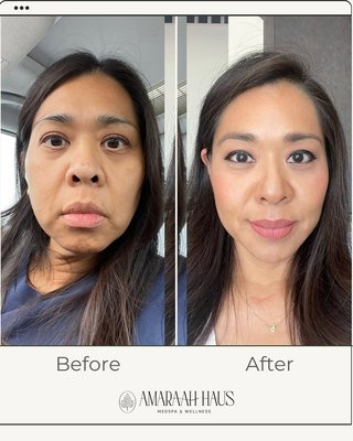 Before and After Gallery - Amaraah Haus is a premier medspa in West Covina led by NP Chona, specializing in advanced non-surgical aesthetics and natural-looking results. We offer XERF structural skin tightening, laser treatments, injectables, facial balancing, under-eye rejuvenation, and personalized body contouring. Our medical team focuses on safe, evidence-based care using modern technology to help you look refreshed, lifted, and confident. Learn more at amaraahhaus.com. Before and After Gallery - Amaraah Haus is a premier medspa in West Covina led by NP Chona, specializing in advanced non-surgical aesthetics and natural-looking results. We offer XERF structural skin tightening, laser treatments, injectables, facial balancing, under-eye rejuvenation, and personalized body contouring. Our medical team focuses on safe, evidence-based care using modern technology to help you look refreshed, lifted, and confident. Learn more at amaraahhaus.com.