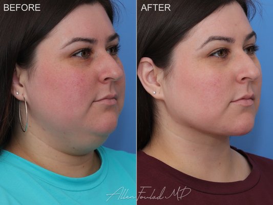 Minimal Incision Deep Sculpting (MIDS) Neck Lift™ - This procedure involves deep neck sculpting using a small incision under the chin. This technique is ideal for younger patients without loose skin who desire superior volume reduction and contouring.