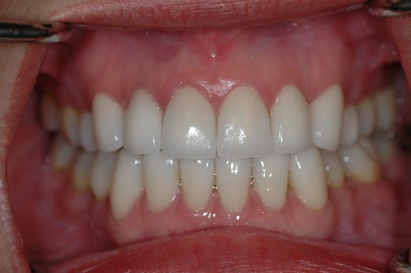 Full-Mouth Veneers & Smile Makeover - This full-mouth veneer case was designed to improve tooth shape, color, symmetry, and overall smile aesthetics. Treatment was carefully planned to create a natural-looking, balanced smile while maintaining proper function and bite. Each smile makeover is customized to the patient’s facial features, goals, and dental needs.
