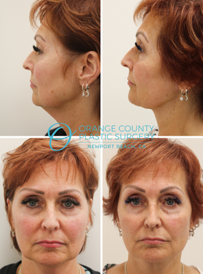 Facelift - Rhytidectomy, the definition of which is a facial surgery that corrects facial aging, is recommended for men and women who have advanced signs of aging, such as deep nasolabial folds, extra laxity in the skin, less facial muscle tone, fat loss, shifting, and other facial-aging issues.