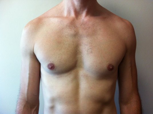 Liposuction of male breast Gynecomastia - Book your appointment today! Liposuction of male breast Gynecomastia - Book your appointment today!