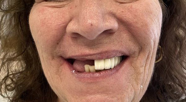 Life Changing Implant Snap on Dentures - These patients had life changing Implant Snap on Denture treatment. Life Changing Implant Snap on Dentures - These patients had life changing Implant Snap on Denture treatment.