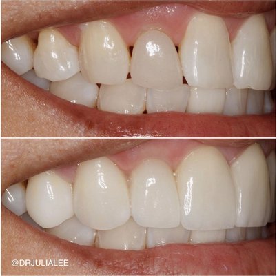 Dental Impant Special - Single Dental Implant Starting at $1,587 a $1,008 Savings! Financing Available. Free Consultation with Dr. Julia includes, Dental Implant Treatment Plan and 3D-Cone Beam X-Rays. Walnut Creek Implant Dentist Dr. Julia Lee has many years of training and real-world experience with dental implants. She is an associate fellow of American Academy Of Implant Dentistry (AAID) and International Congress of Oral Implantologists (ICOI). They will proudly take the time to discuss their credentials, explain the implant process, and show you before and after photos of patients who have improved their smiles with amazing implant technology.